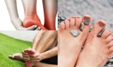 Morton Nöroma Nedir?