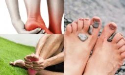 Morton Nöroma Nedir?