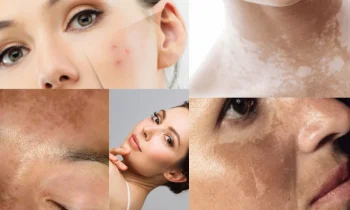 Melasma Tedavisi Nasıl Olmalıdır?