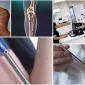 Bacak Uzatma Ameliyatı İçin En iyi Ülke- Best Country For Leg Lengthening Surgery